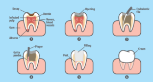 root canal treatment step