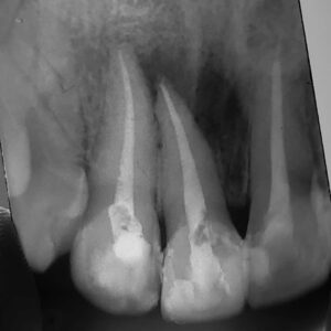 straight root canal