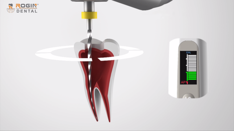 endodontic files