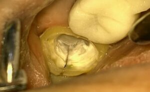 Fig. 2a After resin core removal. A fracture line was observed at a distal aspect.