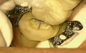 Fig. 4a Mesial root canals. Mesial canals were not filled and calcified. MB canal had  a broken file.