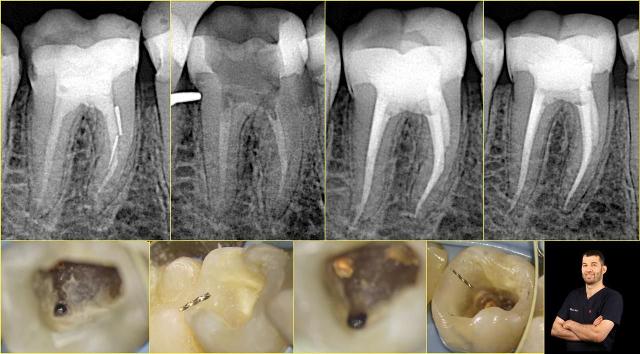 Advanced Endodontic Retreatment: Successful Retrieval Of 2 Broken Files ...