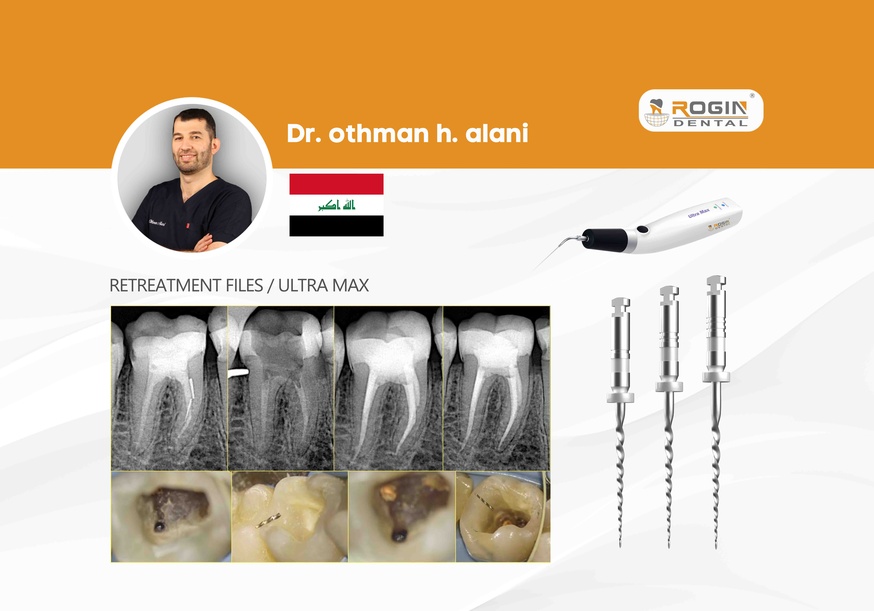 Advanced Endodontic Retreatment: Successful Retrieval Of 2 Broken Files ...
