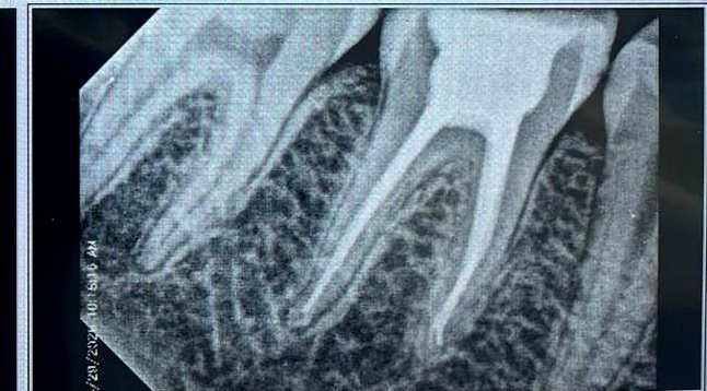 Successful Single-Visit Root Canal Treatment: A Case Study Of ...