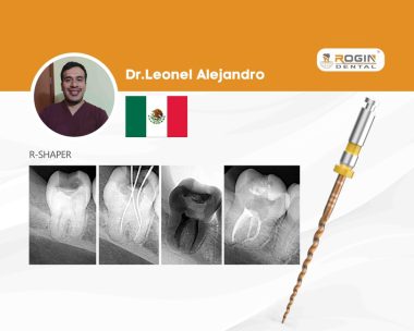 Advanced C-Shaped Canal Retreatment in Tooth 47_cover