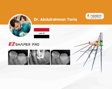Endodontic Management of Tooth #46 with Acute Irreversible Pulpitis and Vertucci Type II Mesial Canals_cover