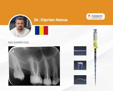 Irreversible Pulpitis Case Made Easy