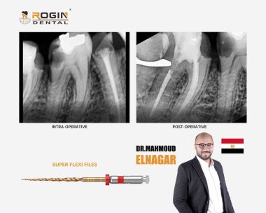 Managing a Large Gingival Polyp and Two Challenging Lower Teeth