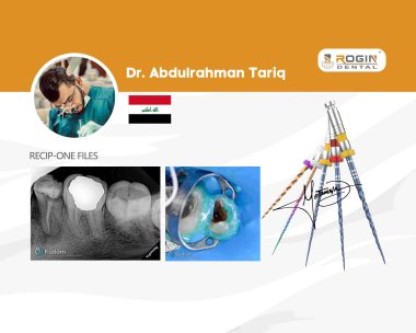 Modern Endodontic Retreatment of a Mandibular Second Premolar with 4 Canals and Apical Split5