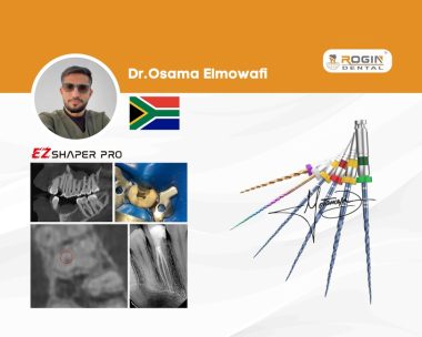 Molarized Maxillary Premolar (Tooth 24) with Three Separate Roots_cover