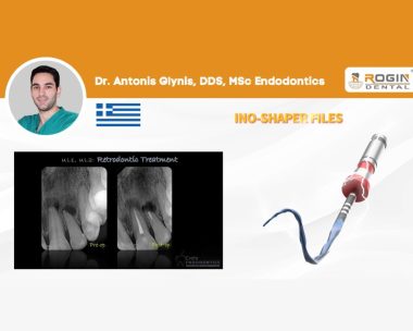 심하게 석회화된 근관도 문제없습니다 – Rogin Ino-Shaper로 근첨 역방향 접근법을 구현하세요