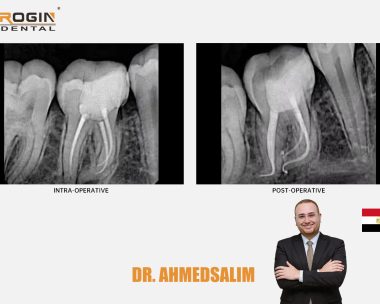 Successful Endodontic Retreatment of a Mandibular First Molar with Severely Curved Canals