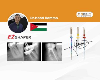 Successful Root Canal Treatment of Mandibular First Molar Using EZ-Shaper Files