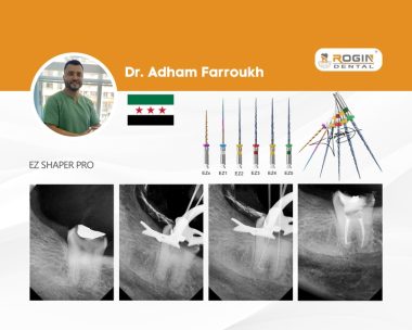 Successful Root Canal Treatment on Tooth 47 with Severe Curvatures Using EZ Shaper Pro_10
