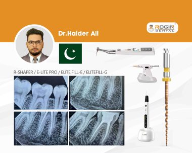 Successful Single-Visit Root Canal Treatment_cover